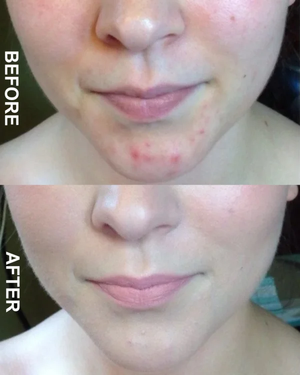 Anti Acne Face Wash for Oily Skin – Sohi Organic Pakistan